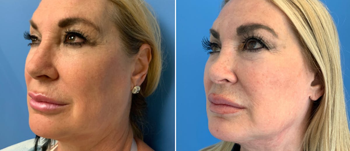 Facelift Before & After Gallery - Patient 38566667 - Image 5