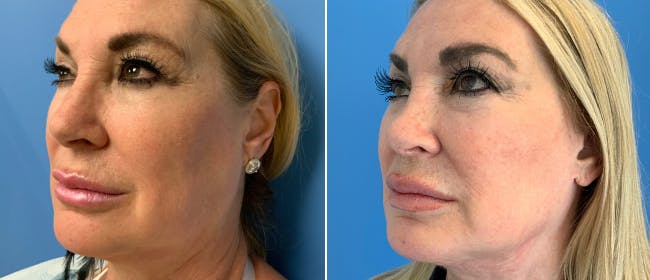 Facelift Before & After Gallery - Patient 38566667 - Image 5
