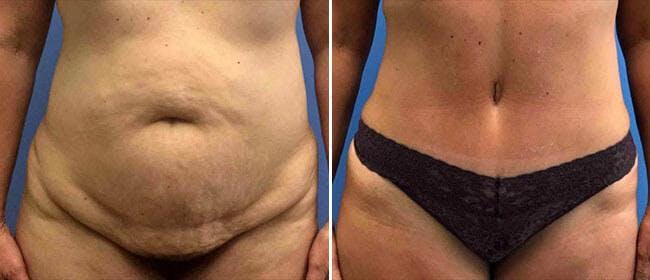 Abdominoplasty (Tummy Tuck) Before & After Gallery - Patient 38566693 - Image 1