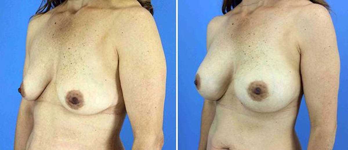 Breast Augmentation Before & After Gallery - Patient 38566694 - Image 1