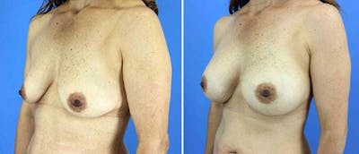 Breast Augmentation Before & After Gallery - Patient 38566694 - Image 1