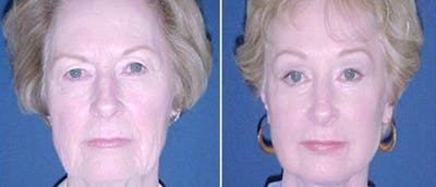 Mid Facelift Before & After Gallery - Patient 38566697 - Image 1