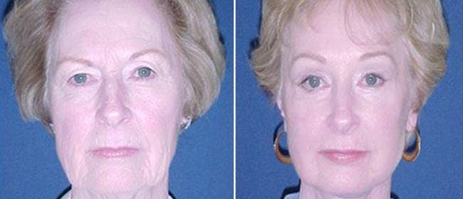 Mid Facelift Before & After Gallery - Patient 38566697 - Image 1