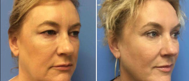 Eyelid Surgery Before & After Gallery - Patient 38566698 - Image 1