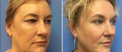 Eyelid Surgery Before & After Gallery - Patient 38566698 - Image 1