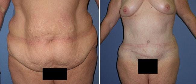 Abdominoplasty (Tummy Tuck) Before & After Gallery - Patient 38566699 - Image 1