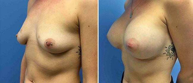 Breast Augmentation Before & After Gallery - Patient 38566701 - Image 1