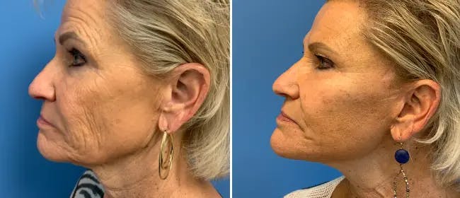 Facelift Before & After Gallery - Patient 38566700 - Image 1