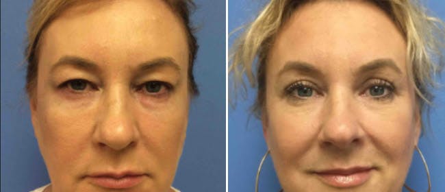 Eyelid Surgery Before & After Gallery - Patient 38566698 - Image 2