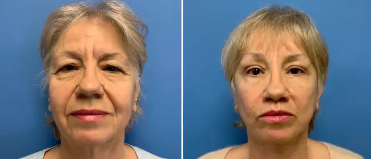 Facelift Before & After Gallery - Patient 38566706 - Image 1