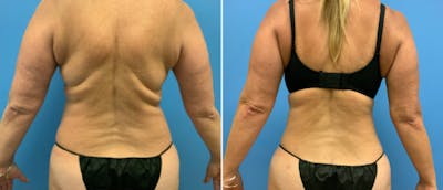 Liposuction / Bodytite Before & After Gallery - Patient 38566711 - Image 1
