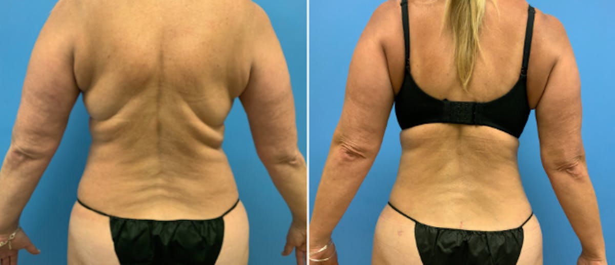 Liposuction Before & After Gallery - Patient 38566711 - Image 1