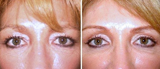 Eyelid Surgery Before & After Gallery - Patient 38566710 - Image 1