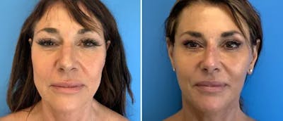 Facelift Before & After Gallery - Patient 38566709 - Image 1