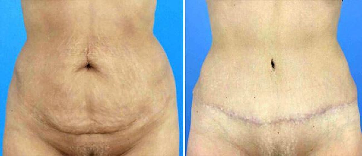 Abdominoplasty (Tummy Tuck) Before & After Gallery - Patient 38566712 - Image 1
