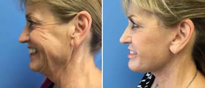 Facelift Before & After Gallery - Patient 38566713 - Image 1