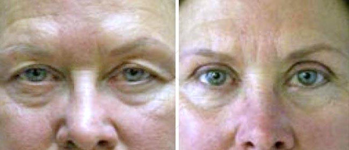 Eyelid Surgery Before & After Gallery - Patient 38566714 - Image 1