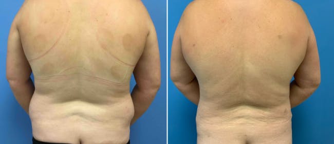 Liposuction Before & After Gallery - Patient 38566717 - Image 1