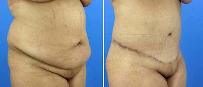 Tummy Tuck Before & After Gallery - Patient 38566716 - Image 1