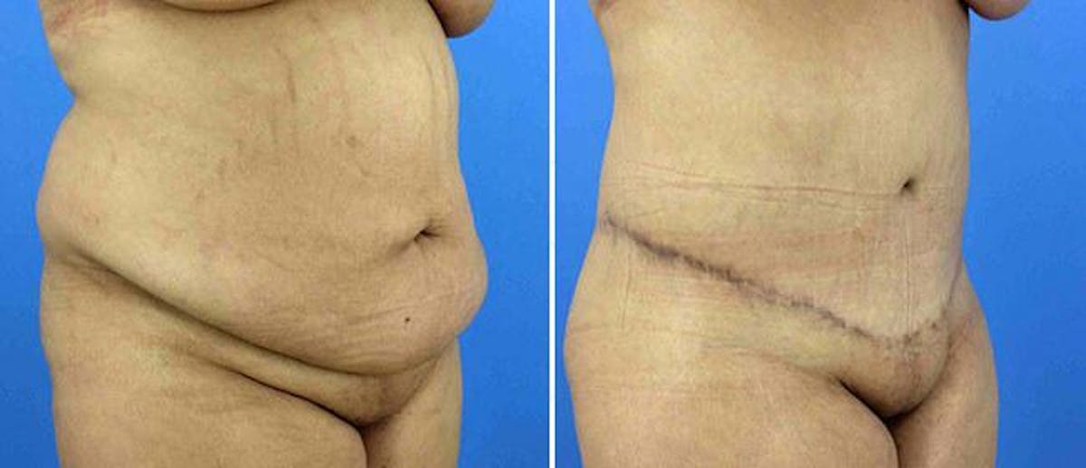 Abdominoplasty (Tummy Tuck) Before & After Gallery - Patient 38566716 - Image 1