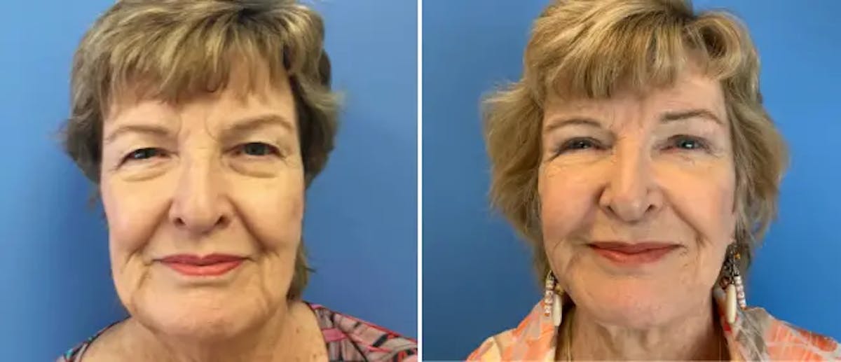 Facelift Before & After Gallery - Patient 38566718 - Image 1