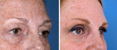 Eyelid Surgery Before & After Gallery - Patient 38566719 - Image 1