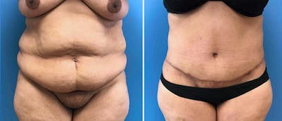Tummy Tuck Before & After Gallery - Patient 38566721 - Image 1