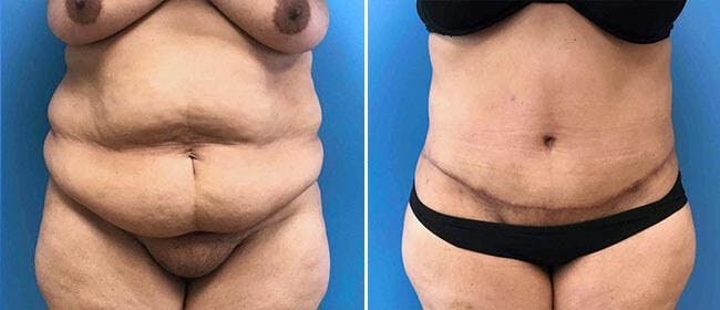 Abdominoplasty (Tummy Tuck) Before & After Gallery - Patient 38566721 - Image 1