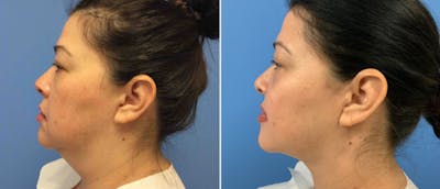 Liposuction Before & After Gallery - Patient 38566722 - Image 1