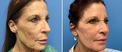 Facelift Before & After Gallery - Patient 38566724 - Image 1