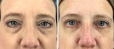 Eyelid Surgery Before & After Gallery - Patient 38566723 - Image 1