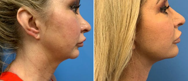 Neck Lift Before & After Gallery - Patient 38566720 - Image 2