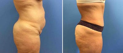 Tummy Tuck Before & After Gallery - Patient 38566726 - Image 1