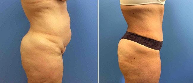 Abdominoplasty (Tummy Tuck) Before & After Gallery - Patient 38566726 - Image 1