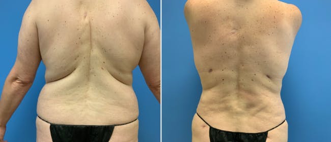 Liposuction Before & After Gallery - Patient 38566729 - Image 1