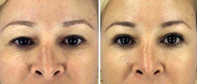 Eyelid Surgery Before & After Gallery - Patient 38566728 - Image 1