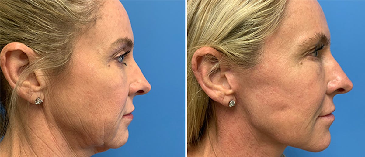 Facelift Before & After Gallery - Patient 38566730 - Image 1
