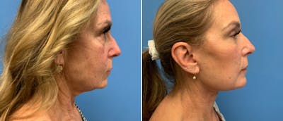 Neck Lift Before & After Gallery - Patient 38566732 - Image 1