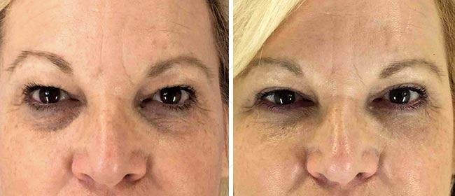 Eyelid Surgery Before & After Gallery - Patient 38566733 - Image 1