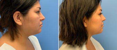 Liposuction Before & After Gallery - Patient 38566736 - Image 1