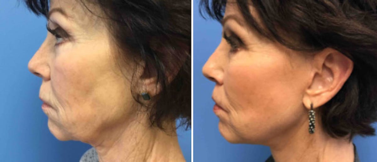 Facelift Before & After Gallery - Patient 38566734 - Image 1
