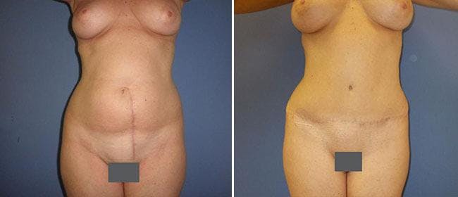 Abdominoplasty (Tummy Tuck) Before & After Gallery - Patient 38566735 - Image 1