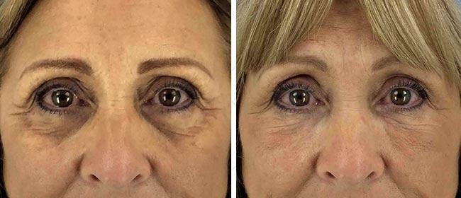 Eyelid Surgery Before & After Gallery - Patient 38566737 - Image 1