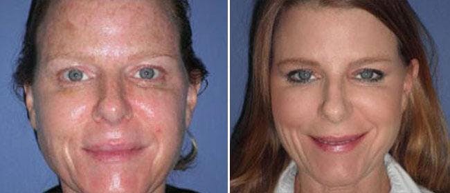 Facelift Before & After Gallery - Patient 38566739 - Image 1