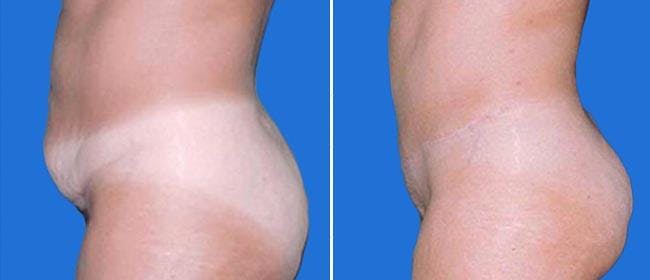 Abdominoplasty (Tummy Tuck) Before & After Gallery - Patient 38566740 - Image 1