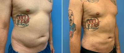 Liposuction / Bodytite Before & After Gallery - Patient 38566741 - Image 1
