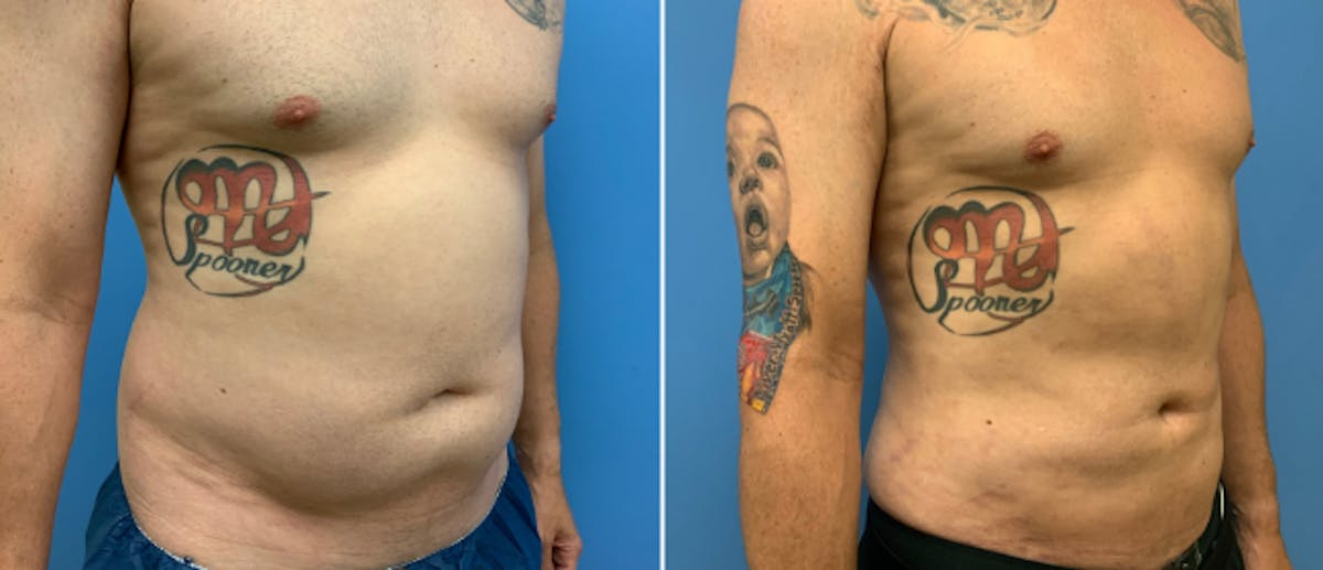 Liposuction Before & After Gallery - Patient 38566741 - Image 1