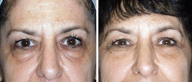 Eyelid Surgery Before & After Gallery - Patient 38566742 - Image 1