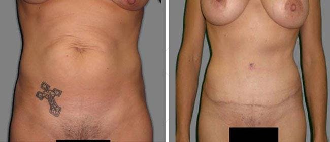 Abdominoplasty (Tummy Tuck) Before & After Gallery - Patient 38566745 - Image 1