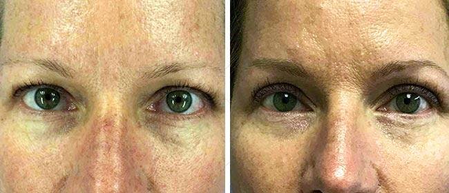 Eyelid Surgery Before & After Gallery - Patient 38566747 - Image 1